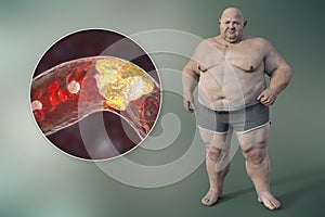 Obesity and atherosclerosis, conceptual 3D illustration. Atheromatous plaque inside artery leading to narrowing of blood vessel in