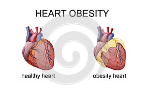 The obesity heart