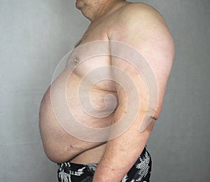 Obesity - Obese Man