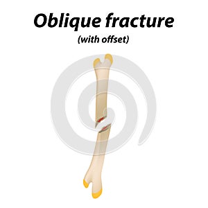 Oblique with offset bone fracture. Infographics. Vector illustration on a lined background.