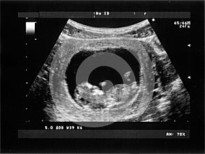 Obstetric Ultrasonography