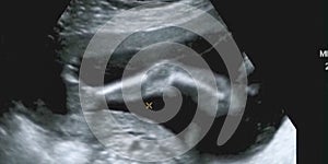 Obstetric Ultrasonography