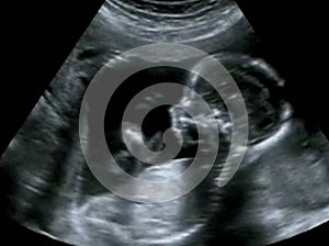 Obstetric Ultrasonography Ultrasound Echography of a first month photo