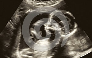 Obstetric Ultrasonography Ultrasound Echography of a first month