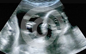 Obstetric Ultrasonography Ultrasound Echography of a first month photo