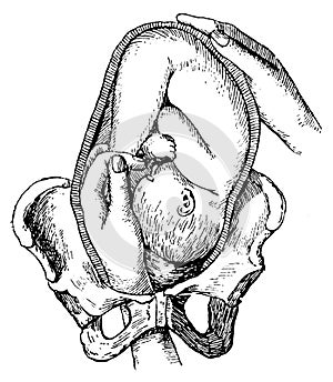 Obstetrics. Childbirth. Illustration of the 19th century.