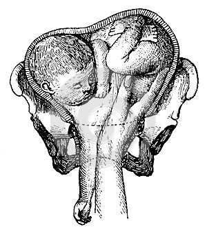 Obstetrics in pathology. Shoulder presentation.