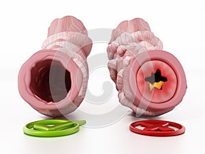 Obstructed and unobstructed bronchial tubes representing asthma. 3D illustration