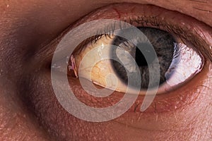 Obstructive Jaundice with severe yellowish discoloration of Eyes