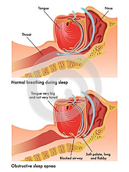 Obstructive sleep apnea