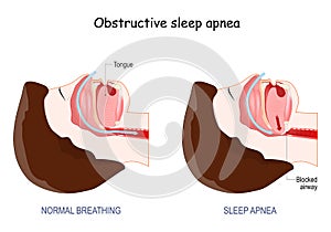 Obstructive Sleep Apnea. normal breathing, and  anatomy of Snoring.