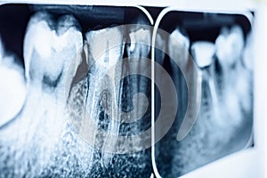 Obturation of Root Canal Systems On X-Ray