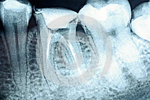 Obturation of Root Canal Systems On X-Ray photo