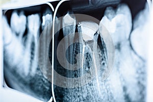 Obturation of Root Canal Systems On X-Ray photo