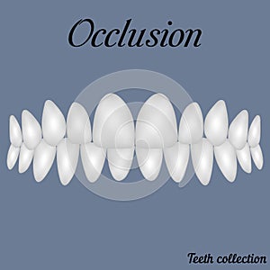 Occlusion clenched teeth