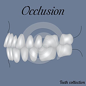Occlusion side view photo