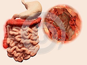 Occurrence of tumors in the gastrointestinal tract