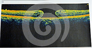 OCT of the eye reveals faint epimacular membrane and full thickness macular hole involving the fovea, surrounding diffuse macular