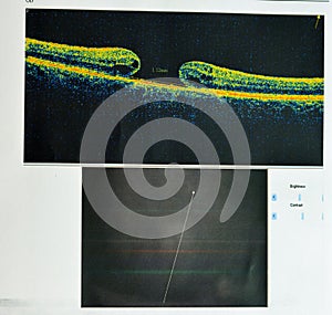 OCT of the eye reveals faint epimacular membrane and full thickness macular hole involving the fovea, surrounding diffuse macular