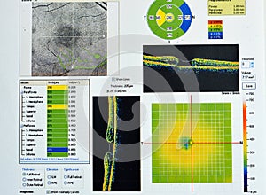 OCT of the eye reveals faint epimacular membrane and full thickness macular hole involving the fovea, surrounding diffuse macular