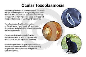 Ocular toxoplasmosis, retinal scar caused by a Toxoplasma gondii infection, scientific illustration photo