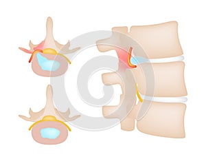 Office syndrome / backache / back bone nerve hurt