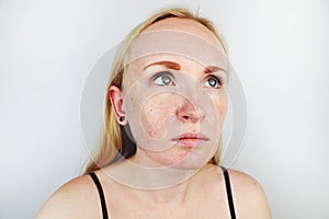 Oily and problem skin. Portrait of a blonde girl with acne, oily skin and pigmentation