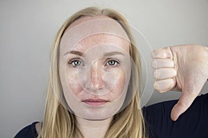 Oily and problem skin. Portrait of a blonde girl with acne, oily skin and pigmentation photo
