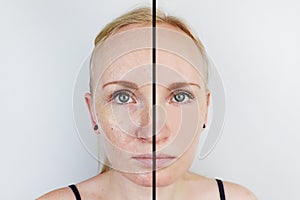 Oily skin and clear skin. Two photos before and after. Portrait of a girl with problem skin
