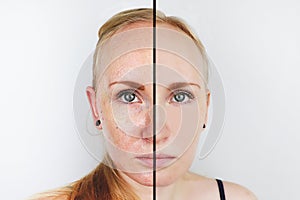 Oily skin and clear skin. Two photos before and after. Portrait of a girl with problem skin