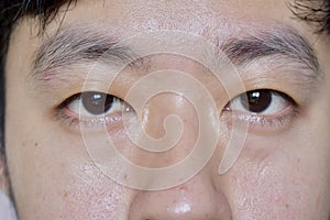 Oily skin with spots or pimples of Asian, Chinese adult young man with monolid or single eyelids. Front view.