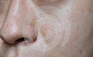 Oily skin with wide pores in face of Southeast Asian, Myanmar or Korean adult young man