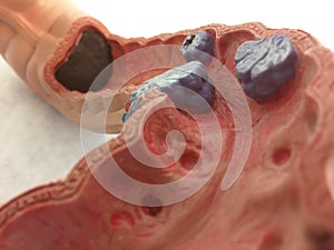 Old anatomical model of Colon with examples of different diseases