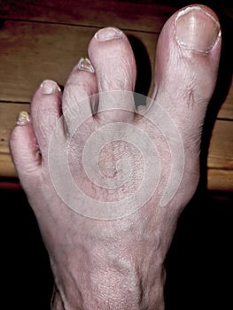 Old Dirty Human Foot Disfigured