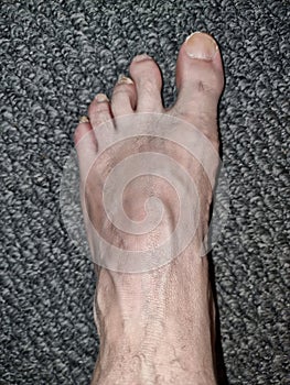 Old Dirty Human Foot Disfigured