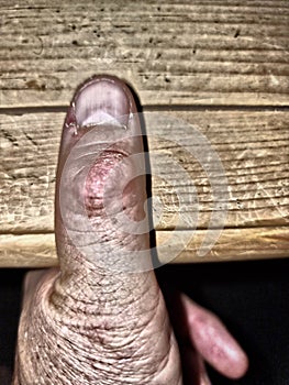 Old Dirty Human Thumb Disfigured photo