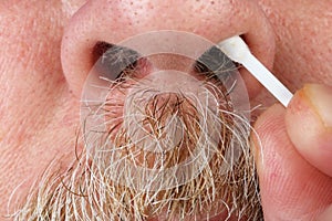 Old elderly allergenic man cleans his nose with a cotton swab  macro