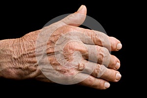 Old hand with arthritis