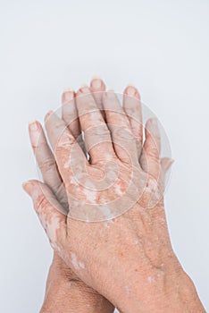 Old hands with vitiligo skin disorder on white background