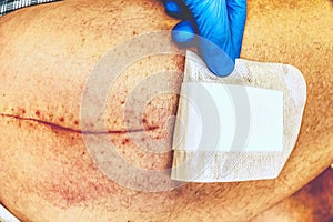 Human leg with postoperative scar of joint surgery. Detail of skin