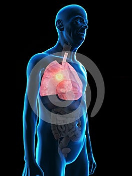 An old mans lung tumor