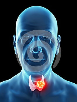 An old mans thyroid gland cancer