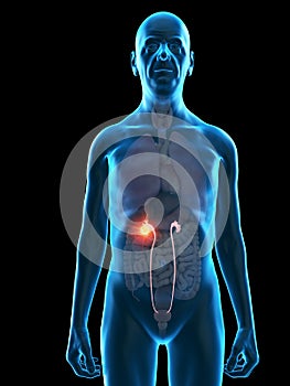 an old mans ureters tumor photo