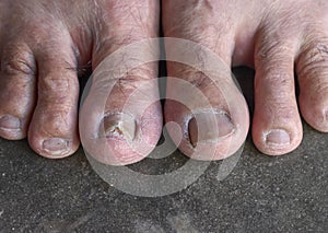 Old manâ€™s feet. Dry foot and skin aging