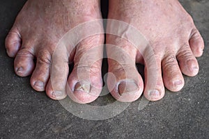 Old manâ€™s feet. Dry foot and skin aging