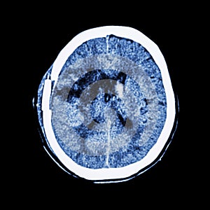 Old right basal ganglia hemorrhage with brain edema ( status post craniotomy ) ( Hemorrhagic stroke )