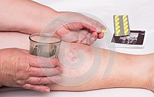 Old woman holding a glass of water and a pill for varicose veins on the background of the legs with varicose veins