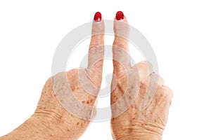 Old Woman`s Hands Deformed From Rheumatoid Arthritis