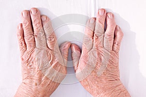 Old woman's hands geformed from rheumatoid arthritis