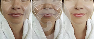 Old woman wrinkles  arrow sagging  effect  correction before after lifting plastic filler